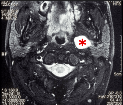 MRT-Darstellung eines Innenlappentumors(*) der Ohrspeicheldrüse